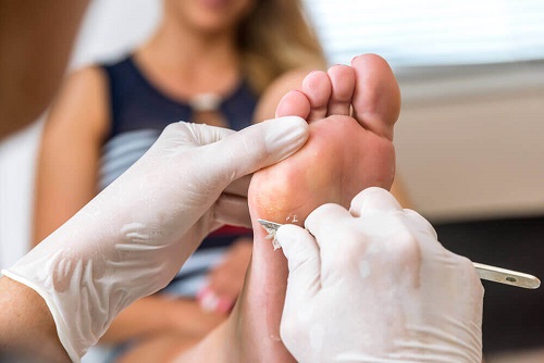 Wratten op de voet verwijderen