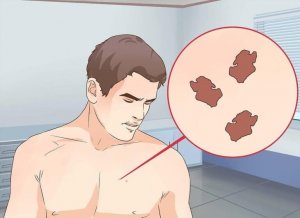 Wat doe je als je een abnormaal vlekje vindt?