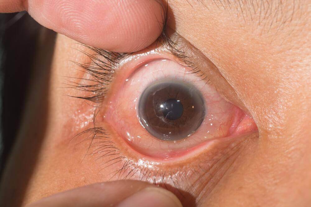 Achterste subcapsulair cataract en symptomen van cataract