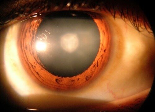 Kerncataract en symptomen van cataract