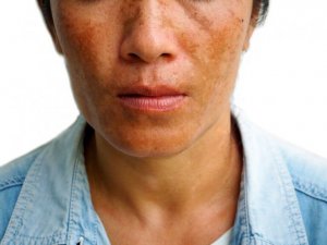 Drie manieren om melasma te behandelen