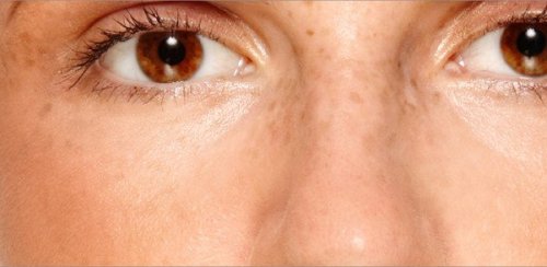 Melasma in het gezicht