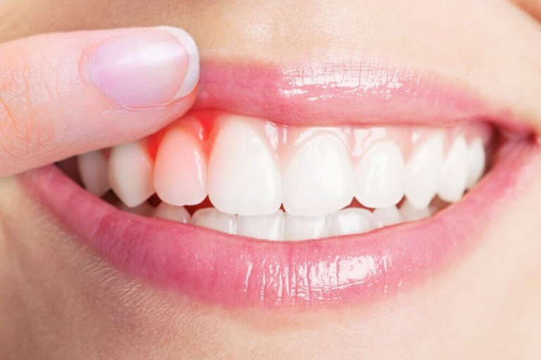 5 remedies voor het behandelen van een tandvleesontsteking