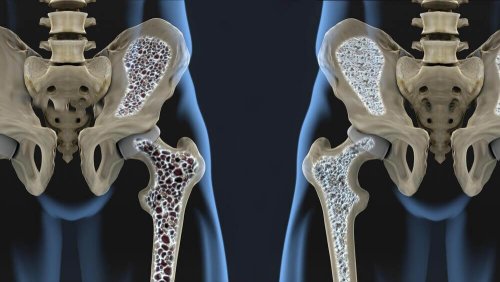 Hoe je osteoporose kan voorkomen met deze 6 voedingstips