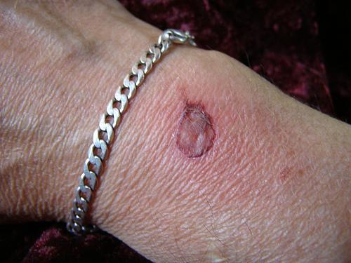 pols met brandblaar