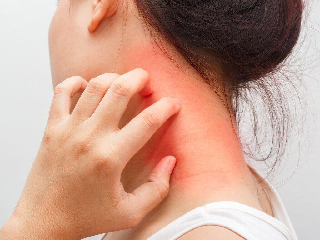 Dermatitis en huiduitslag