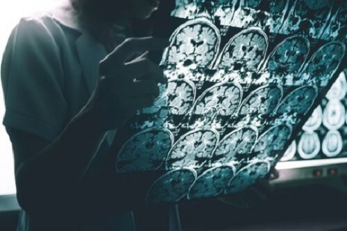 De voornaamste symptomen van de ziekte van Alzheimer