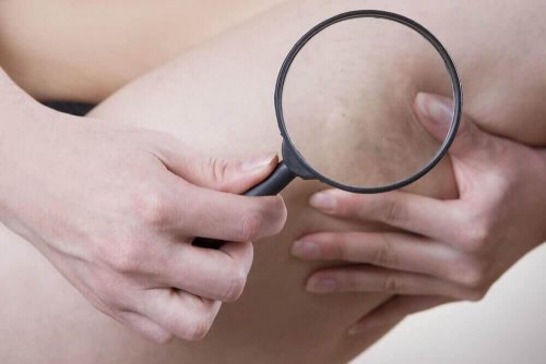 Oorzaken van cellulitis