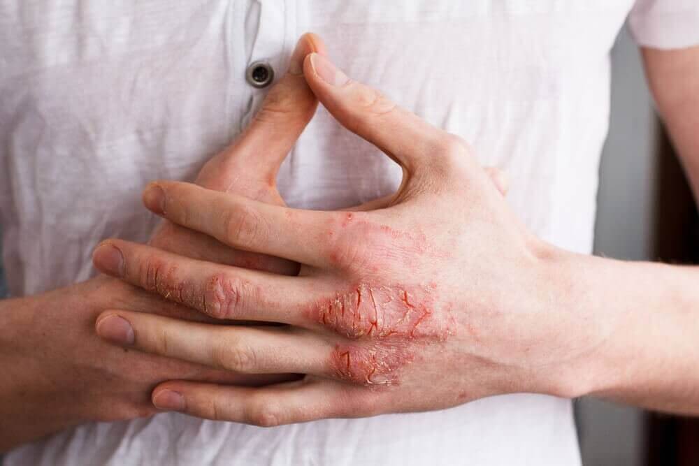 eczeem op de hand