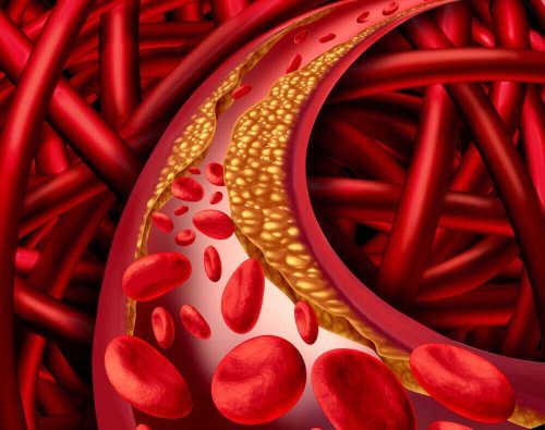 Hoog cholesterol