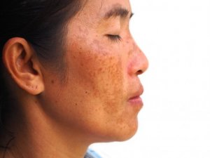 Melasma behandelen met yoghurt, banaan en citroen