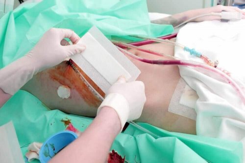 Een niertransplantatie kan leiden tot complicaties