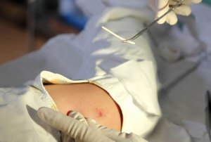 Kun je nog steeds zwanger worden met een etonogestrel implantaat?