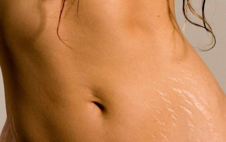buik met striae