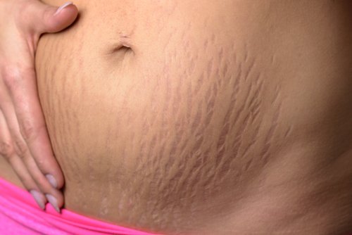 buik met striae