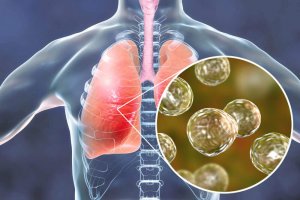 5 remedies voor symptomen van blastomycose