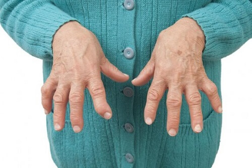 Reumatische artritis verlichten met geneeskrachtige remedies