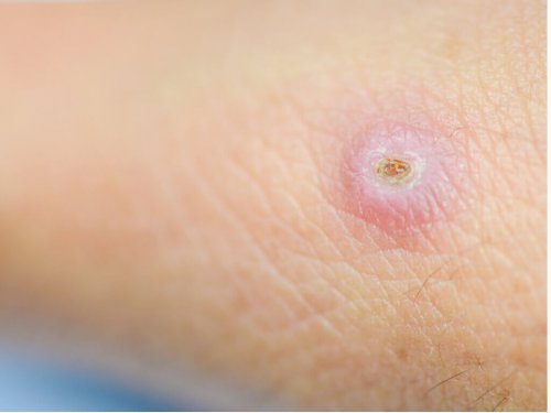 Waarom vormen steenpuisten zich