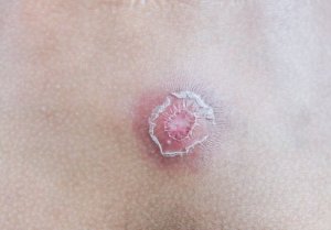 Zeven tips hoe je van steenpuisten kunt afkomen