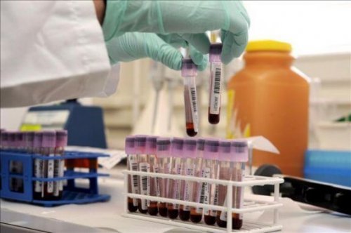 HIV onderzoek