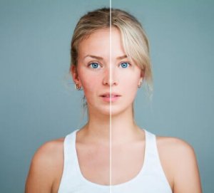 Voedingsstoffen die rosacea kunnen verminderen