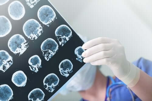 Een arts houdt foto's van een hersenscan vast