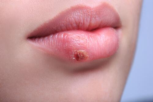 Zweer op de lippen door zonschade