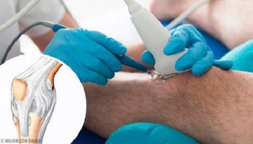 De voordelen van een artroscopie van de knie