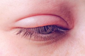 Blefaritis: oorzaken, symptomen en behandeling