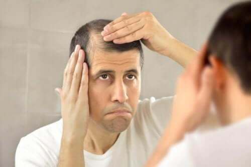 Man met last van alopecia