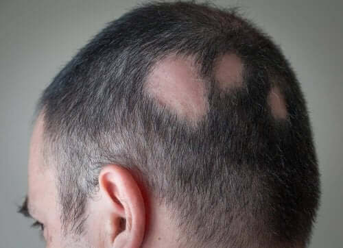 Man met alopecia