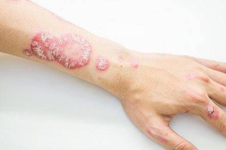 Psoriasis op de arm