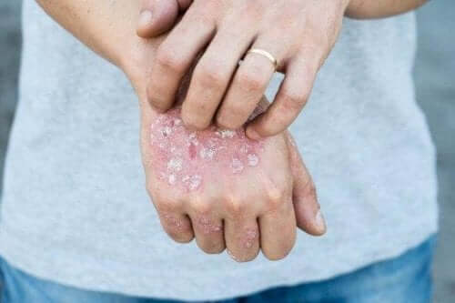 Vijf behandelingen met kruiden tegen psoriasis