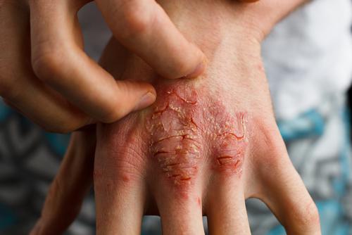 Wat is artritis psoriatica