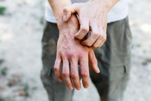 6 huismiddeltjes om contactdermatitis te behandelen