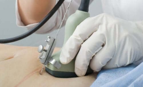 Vrouw krijgt controle voor een mola-zwangerschap