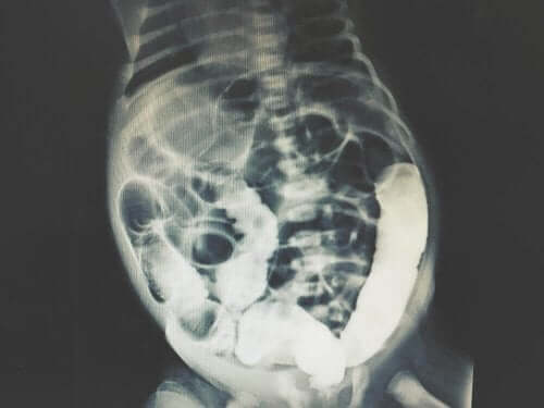 Röntgen peritoneale dialyse