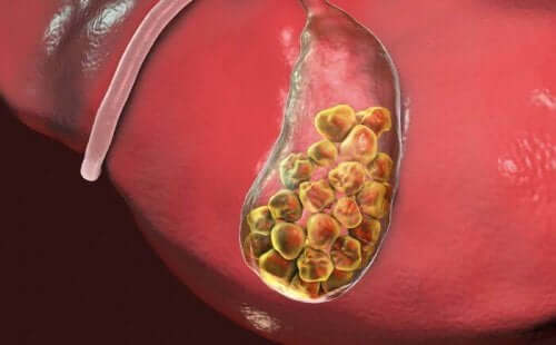 Galstenen ontwikkellen zich in de galblaas