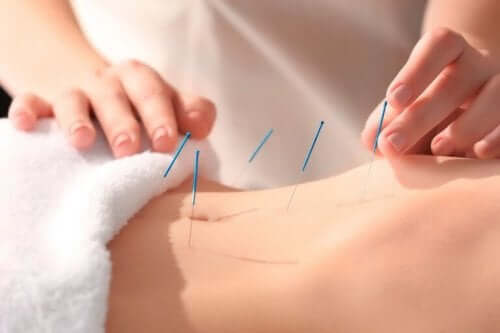 Acupunctuurbehandeling