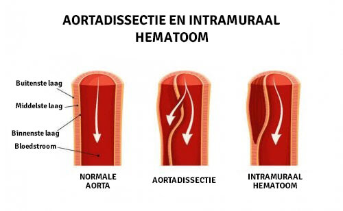 Aortadissectie