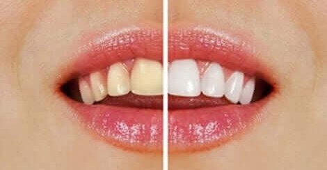Natuurlijke producten om tanden te bleken