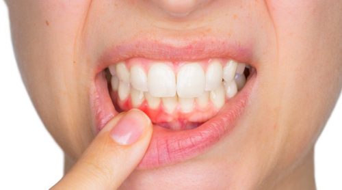 Tandabcessen en hoe ze te behandelen