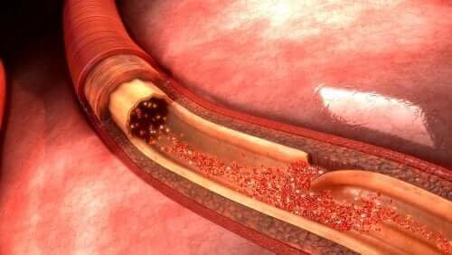 Wat is een aortadissectie en wat is de oorzaak?