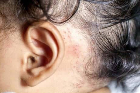 Behandeling van psoriasis bij kinderen