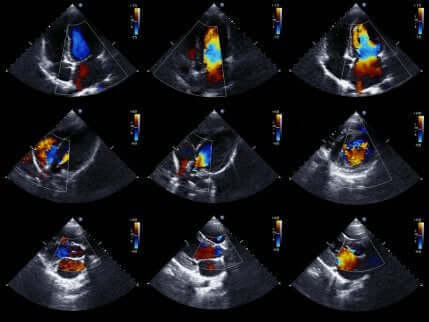Echocardiogram