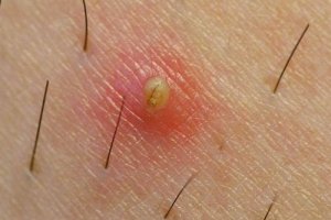 Hoe ingegroeide haartjes te voorkomen