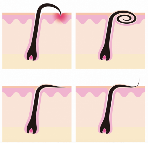 Tekening met uitleg hoe haren ingroeien