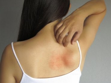 5 remedies om huiduitslag te verlichten