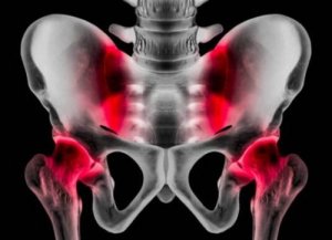 Atletische pubalgie: oorzaken, symptomen en behandeling