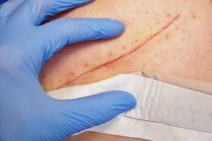 Technieken voor de behandeling van grote wonden